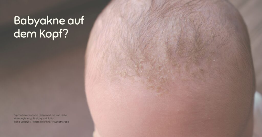 Akne bei Neugeborenen. Weinen beim Anpassungsstörungen und Regulationsstörung. Psychotherapeutische Heilpraxis Laut und Liebe Kisenbegleitung, Bindung und Schlaf Ingrid Scherzer, Heilpraktikerin für Psychotherapie Schreibaby, Kolik, Highneedbaby, Regulationsstörung.